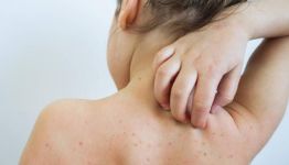 7 заразени с варицела отчита РЗИ / Новини от Казанлък