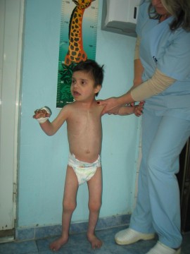 11-годишно дете от Казанлък е в много тежко състояниe