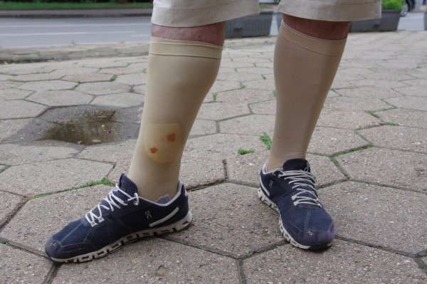 След катастрофа и кома Красимир Низамов прохожда отново по чудо, но се нуждае от скъпа операция в Турция