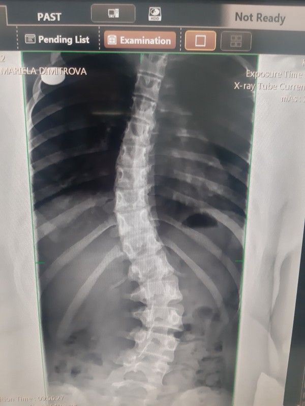 13-годишно дете от Казанлък със сколиоза се нуждае от спешна операция в Германия