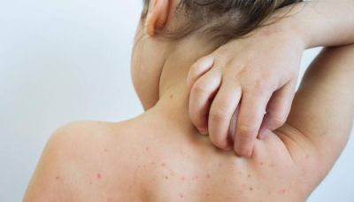 7 заразени с варицела отчита РЗИ / Новини от Казанлък