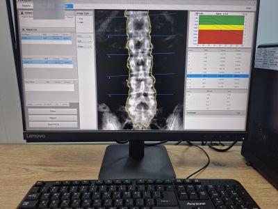Поликлиниката в Казанлък вече разполага с нов високотехнологичен апарат за прецизна диагностика на костното здраве
